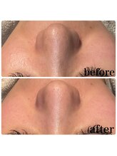 ディオーネ 春日井勝川店(Dione)/毛穴洗浄