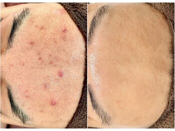 エヌエクラ(N.eclat.)/ニキビケア