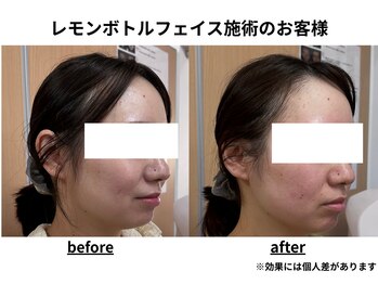 トータルビューティーみつとも/レモンボトル/顔のたるみ/二重顎
