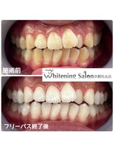 ホワイトニングサロン 京都烏丸店/ホワイトニング施術例
