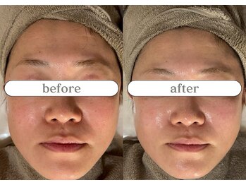 リスタ(RSTA)/【BEFORE/AFTER】