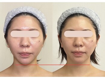 ソルニコン(Solnikon)の写真/小顔ツヤ肌の専門店☆看護師の小顔術×韓国肌管理で、ハリ・ツヤのある「水光肌」へ♪［小顔/毛穴/ニキビ］