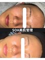 韓国肌管理室 ソア(soa)&nbsp;5年間、色々試しても改善しなかった毛穴・赤みがここまで変化。