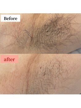 ダイア(DIA)/★圧倒的効果★ メンズ 脇脱毛