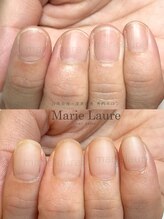 マリーロール 梅田店(Marie Laure)/深爪矯正/自爪育成/自爪風