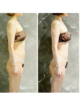 インディバ 六本木/【背中腹部二の腕集中ケア】