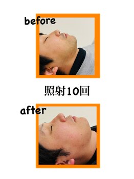 ナルフロウ(nalufurou)/ヒゲ脱毛/メンズ脱毛/全身脱毛