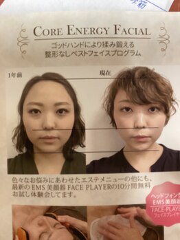 グレマ(grema)/ビフォーアフター