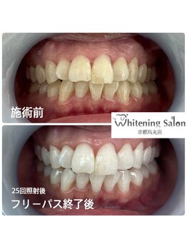 ホワイトニングサロン 京都烏丸店/ホワイトニング施術例
