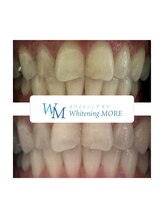 ホワイトニング モア(Whitening MORE)/ビフォーアフター