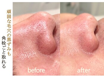 イニジアエリート 池袋店(inizia elite)/オゾン泡洗顔 池袋