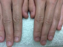 ネイルネイル 南森町店(nailnail)/深爪（before）