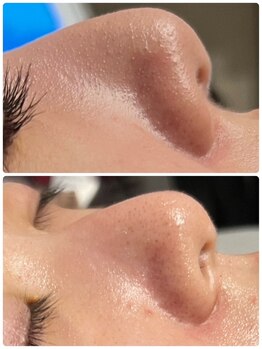 エイチビューティーラボ(h Beauty labo)/毛穴洗浄