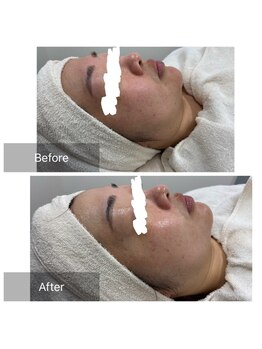 MTサロン 飯塚店/赤ら顔・毛穴の改善♪