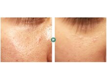 ハルリ(Haruri)/気になる三角ゾーンの毛穴の開き