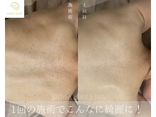 サロンドレナ 名駅店/ハーブピーリング サロンドレナ