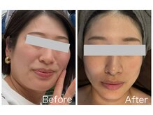 なごみ 菊池店/レモンボトル進化版◆脂肪分解液