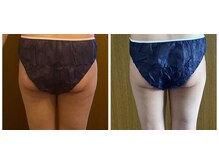 アリス 赤坂/太もも&バナナロール