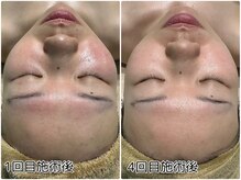 リリアン(Re:lien)/ハーブピーリング