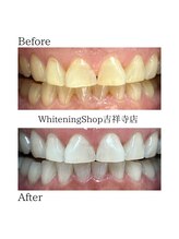 ホワイトニングショップ 吉祥寺店/【ビフォーアフター】