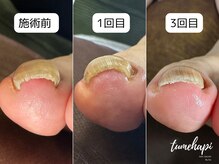 ツメハピ(tumehapi)の雰囲気（巻き爪はしっかりケアをすると改善されます。痛みは1日で解消◎）