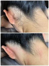 ルーメ(lume)/うなじ脱毛/高校生女の子