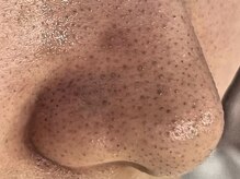 フェイシャル/脱毛/マッサージ/ドライヘッドスパ/毛穴/三軒茶屋