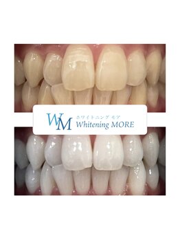ホワイトニング モア(Whitening MORE)/ビフォーアフター