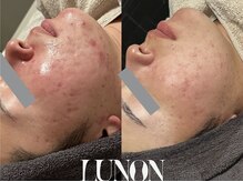 ルノン 天神店(LUNON)/肌質改善《経過》