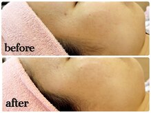 シルク(Cilk)/30代前半 お悩み：ニキビ