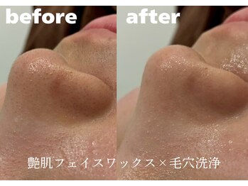 ホワイトラボ 堺東(White labo)/【10代女性 施術5回目の効果】