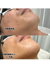 ビビ(BB)/ひげ脱毛４回目のお客様☆