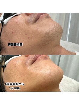 ビビ(BB)/ひげ脱毛４回目のお客様☆