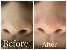 オレンジ(Orange)/【鼻専用】毛穴・角質ケア60分