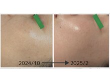 イロドリ(irodori)/肌改善♪健康なお肌へ☆