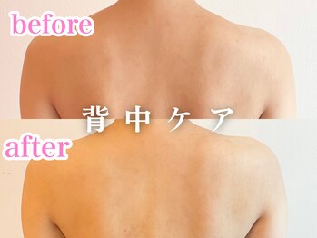 レヴェリー 心斎橋店(REVERIE)/‐ ＨＩＲＦラジオ波 ‐