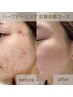 【肌デトックス/剥離あり】医療提携リベルハーブピーリング  ¥33000→¥22000