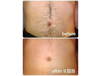 ノノケケ(NONOKEKE)/【メンズ脱毛】　全身脱毛