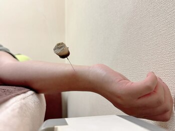 命水鍼灸院/手首不調【新宿/鍼灸】