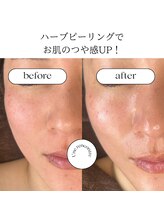 ユヌランコント 岐阜店(Une rencontre)/ハーブピーリング