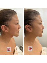 ハズキ(HAZUKI)/もたつきフェイスラインが凄改善