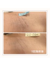 エアリアル 博多店/ワキ脱毛　before→after