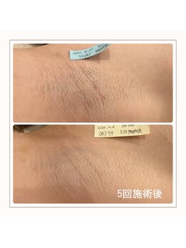 エアリアル 博多店/ワキ脱毛　before→after