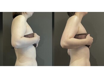 ステラ(Stella)/フェイスラインもこんなに変わる