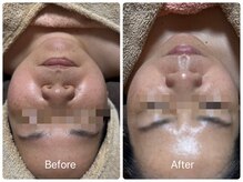 エシャーム(echarme)/毛穴引き締め・たるみケア