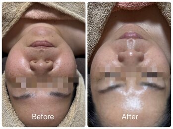 エシャーム(echarme)/毛穴引き締め・たるみケア