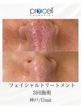 ユミト(Umit)/プロセルフェイシャル