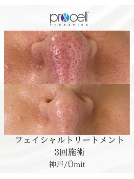 ユミト(Umit)/プロセルフェイシャル