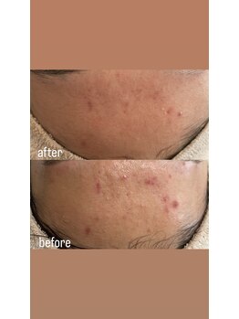 リュミエール(LUMIERE)/ニキビケアもお任せ☆