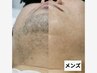 【メンズヒゲ脱毛・都度】２か所 6,600円
